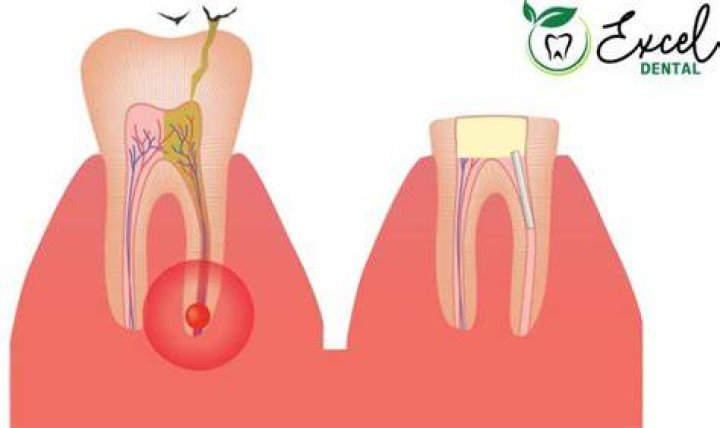 Can a root canal be done if there is an infection?