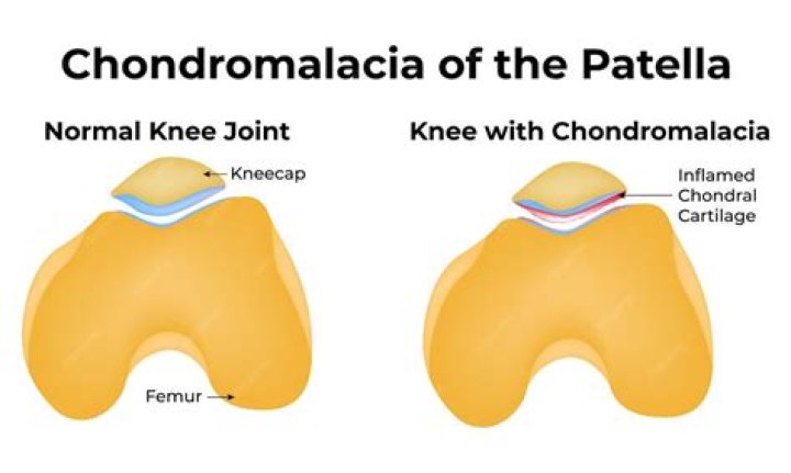 Can chondromalacia patella be caused by trauma?