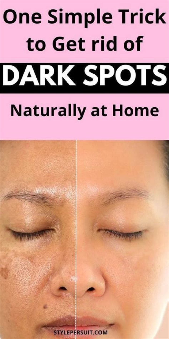 How can I remove dark spots at home naturally?