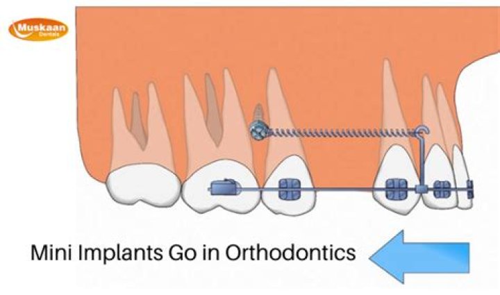 How do mini implants go in orthodontics?