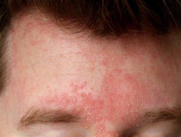 How do you treat seborrheic dermatitis on the face?