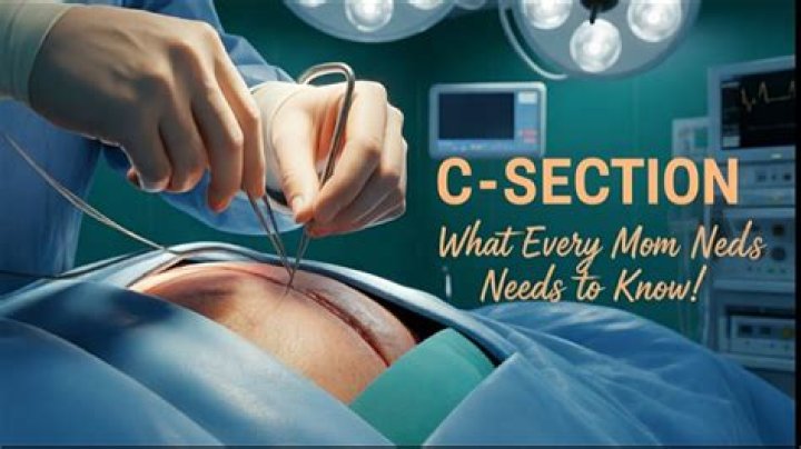 How many C-sections can you have in a lifetime?
