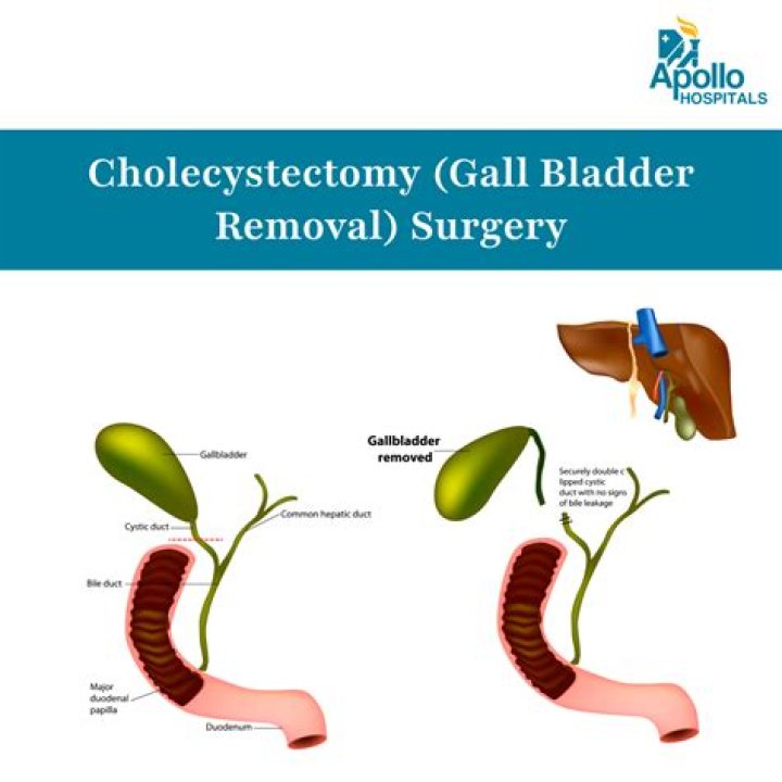 Is gas worse after gallbladder removal?