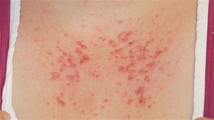 Is PMLE cancerous?