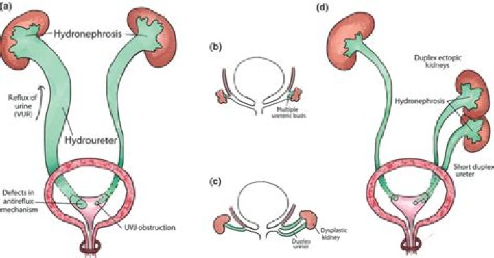 What causes ectopic ureter?