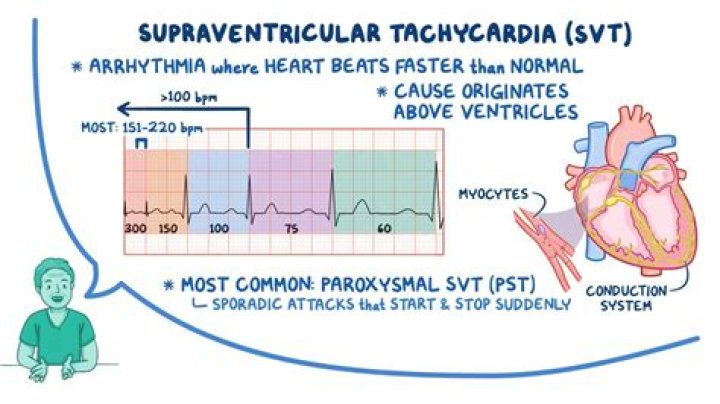 What does sinus tachycardia with PVCs mean?
