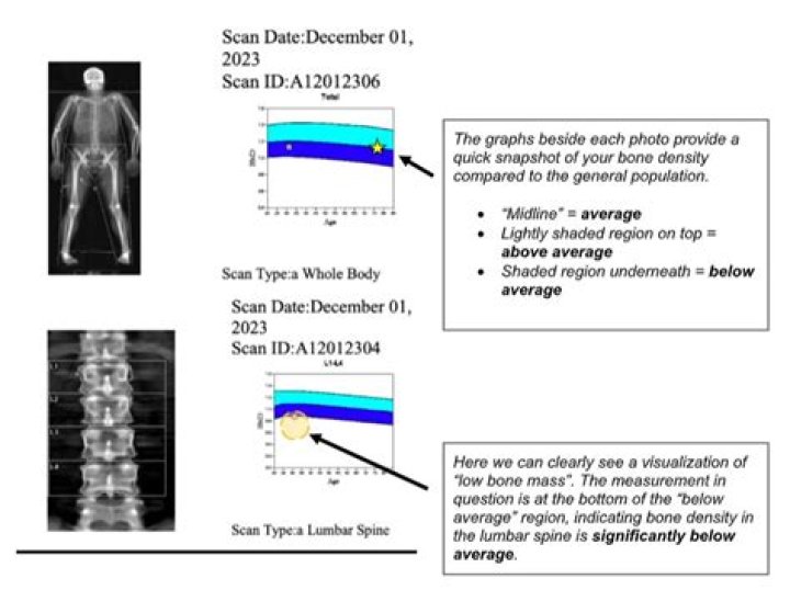 What is the CPT code for bone density scan?