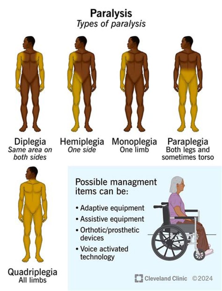 What is the difference between hemiplegia paraplegia and quadriplegia?
