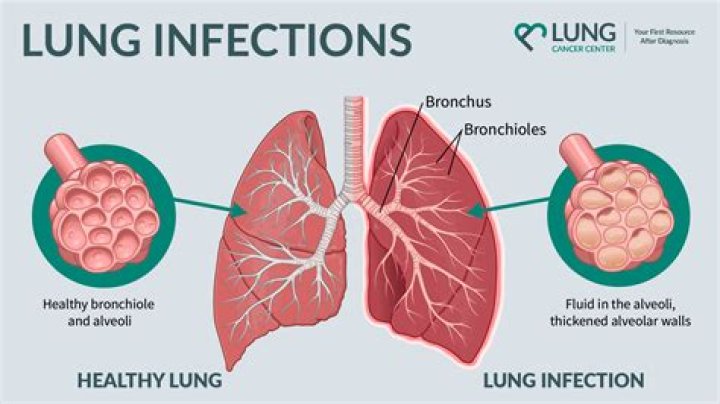 Which type of pollution causes lungs infection?