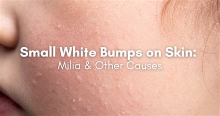 Why do I have white raised bumps on my legs?