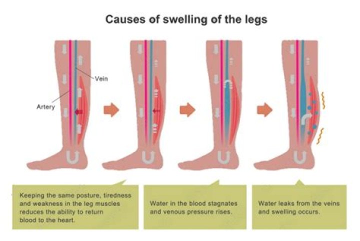 Why does my leg swell after running?